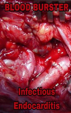 Download Blood Burster - Infectious Endocarditis